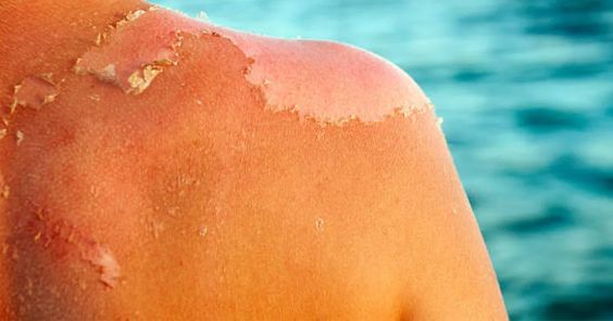 Treating Sunburn-Induced Peeling